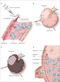 11.09.2021 · prostate cancer ct scan with contrast. References In Mri With A Lymph Node Specific Contrast Agent As An Alternative To Ct Scan And Lymph Node Dissection In Patients With Prostate Cancer A Prospective Multicohort Study The Lancet Oncology
