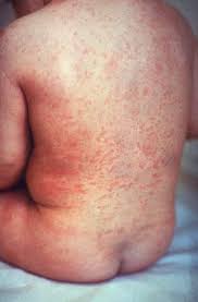 La malattia viene anche definita come quinta in quanto è stata considerata come la quinta malattia che si manifesta nell'infanzia dopo morbillo, scarlattina, rosolia e morbo di dukes (o quarta malattia). Cause E Sintomi Della Scarlattina In Un Bambino