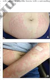 Image result for pruritic urticarial papules and plaques of pregnancy
