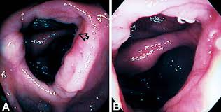 Image result for Pinworm