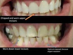 If you grind your teeth while you're awake, it might be useful to record how often you grind your teeth each day. Signs You Grind Your Teeth In Your Sleep Teethwalls