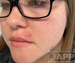 Monroe piercing done with a gorgeous prong set from our friends at NeoMetal  Titanium Body Jewelry Can't wait to downsize this one! Sideview in comments  Click our book now button to get