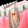 Single Visit Root Canal Treatment product image