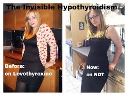 How I Lost The Weight I Gained From Hypothyroidism Underactive Thyroid Thyroid Treatment Thyroid Medication