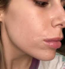 Compare prices for generic soolantra substitutes: My Before And After Soolantra Details In Comments Rosacea