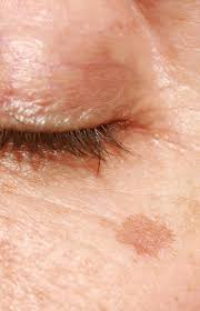 El mejor tratamiento para las manchas de sol en la piel. Restaurante Llave Inglesa Calendario Como Quitar Las Manchas Oscuras De La Piel Mydoclabs Com