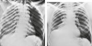 Pleural effusion is classically divided into transudate and exudate based on the light criteria. 15 Pleura And Pleural Disorders Radiology Key