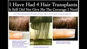 I used hair extensions to hide my hair loss and it was the best decision ever. Men S Hair Extensions For Thinning Balding Enhances Post Hair Transplant Surgery Youtube