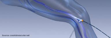 Image result for Radiofrequency Surgery