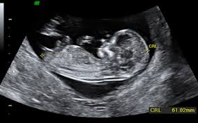 Semana 12 Triple Screening Y Ecografia Del 1er Trimestre Embarazo Y Maternidad