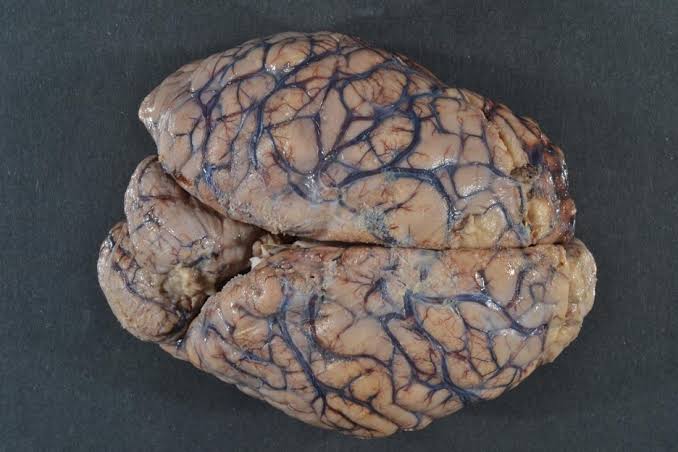 Brain Death | The Autopsy Book