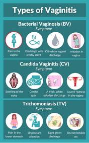 Image result for Vaginitis