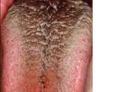 Image result for brown tongue symptoms