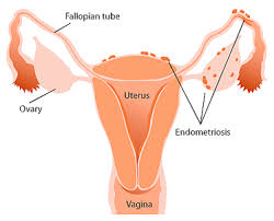 Endometriosis is more common in women who are having fertility issues, but it does not necessarily cause infertility. Endometriosis Physiopedia