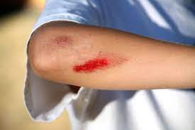 In certain types of wounds, developing an infection is more likely. How To Clean A Graze First Aid For Life