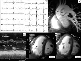 Image result for Exercise Induced Syncope