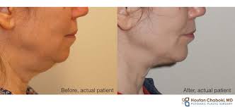 Ultherapy costs around $2,200 for one treatment. Treating A Double Chin Or Submental Fullness Liposuction Chin Implant Or Facelift
