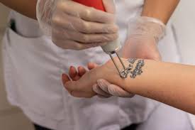 Erase the canvas will remove unwanted or outgrown tattoos and skin blemishes on the most delicate skin. Laser Tattoo Removal Richmond Bodyvie Advanced Aesthetics Clinic