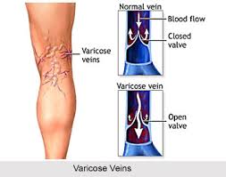 We did not find results for: Yoga For Varicose Veins