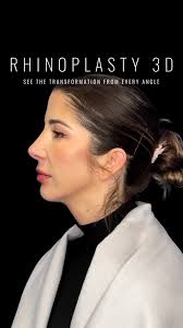 360° of confidence. 🔄✨ See the change from every angle., This beautiful  patient came to us wanting to correct a dorsal hump that impacted her  profile. Now, over a year post-rhinoplasty, her refined, ...