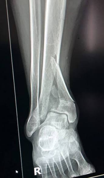 Ankle Pilon Fracture Treatment & Staged ORIF Surgery in Jamshedpur | Dr. Pritpal Singh Saini