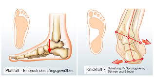 Plattfuss Bei Kindern Was Tun