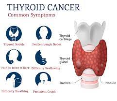 Thyroid cancer typically doesn't cause any signs or symptoms early in the disease. Thyroid Cancer Treatment In Punjab Thyroid Cancer Treatment Cost In Ludhiana