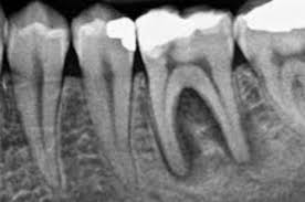 How to say root canal in japanese. When Should You Remove Your Tooth Oceansight Dental Implants