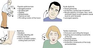 Image Result For Tardive Dyskinesia Nursing School Notes Nursing Mnemonics Psych Nurse
