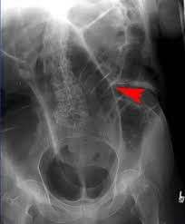 Image result for Sigmoid Volvulus