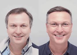 Alan Dobkin's STRIP FUT Hair Transplant Result