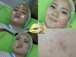 Acnes treatment series adalah rangkaian produk untuk mengatasi jerawat. Beauty Report Review Zap Premier Zap Photo Facial Review Tiaranab