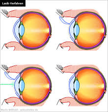 Wann kommt diese therapie zum einsatz? Augenlasern Lasik Verfahren Kosten Risiken