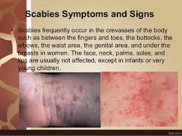 The 2 most widely used treatments for scabies are permethrin cream and malathion lotion (brand name derbac m). Best Cream For Scabies Treatment