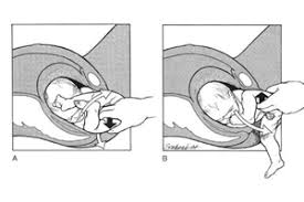 Image result for Breech Delivery