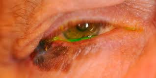 Sebaceous carcinoma is a rare type of cancer that begins in an oil gland in your skin. Eyelid Skin Cancer Photos