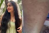 What Are Hives, The Horrible Rash Adah Sharma Was Hospitalised For ...