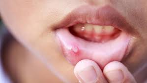 Maybe you would like to learn more about one of these? 7 Obat Alami Untuk Mengatasi Sariawan Si Kecil