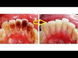 実はリステリンはとてつもなくヤバい万能薬だった 驚愕の効果をもたらす15の裏ワザ 口臭や足の臭いだけじゃない他の効果とは youtube 健康 健康になる ヘルスフィットネス