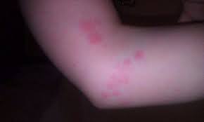 Pictures Of Bed Bug Bites On Kids Bed Bug Bites Bed Bugs Bug Bites