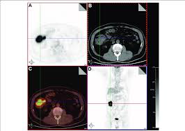 The main part of the large intestine is called the colon, which is about 150 cm long. Case Study Of A Patient With Ascending Colon Cancer A Transaxial Pet Download Scientific Diagram