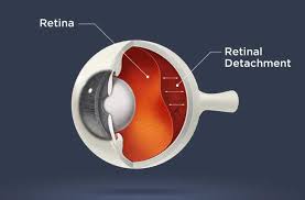 In a study published in american journal of epidemiology, researchers found myopia was a clear risk factor for retinal detachment. Top 7 Faqs About Retinal Detachment Magrabi Hospitals