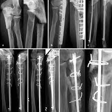 Pdf Intramedull Re Nagelosteosynthese Der Ulna In Der Revisionschirurgie