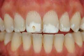 Treatment Of Extensive White Spots By Resin Infiltration Styleitaliano Org