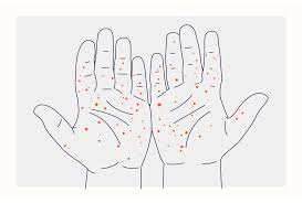 Image result for Hand foot and mouth disease HFMD roof of mouth