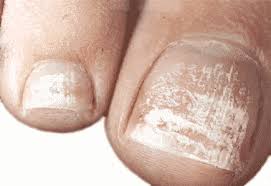 Nail fungus is a widespread disease which can be treated at home without necessary nail removal. White Toenail Fungus Nails Turning White Due To Fungal Infection