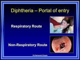 Redness and swelling over fauces exudates on the tonsils coalesces to form grayish white pseudo membrane regional lymph nodes are inflamed sore throat and dysphagia. Diphtheria Dr Harivansh Chopra Md Dch Professor Ppt Download