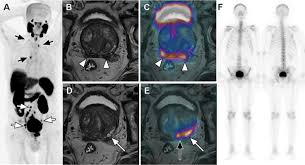 Being armed with information is vital to begin the fight. Scielo Brasil Clinical Perspectives Of Psma Pet Mri For Prostate Cancer Clinical Perspectives Of Psma Pet Mri For Prostate Cancer