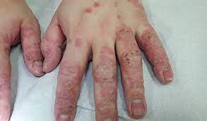 Figure 3 Atypische Hand Fuss Mund Krankheit Springerlink