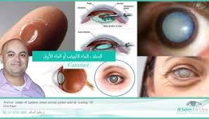 مضاعفات عملية المياه البيضاء عيادات السالم لطب و جراحة العين أ د خليل السالم